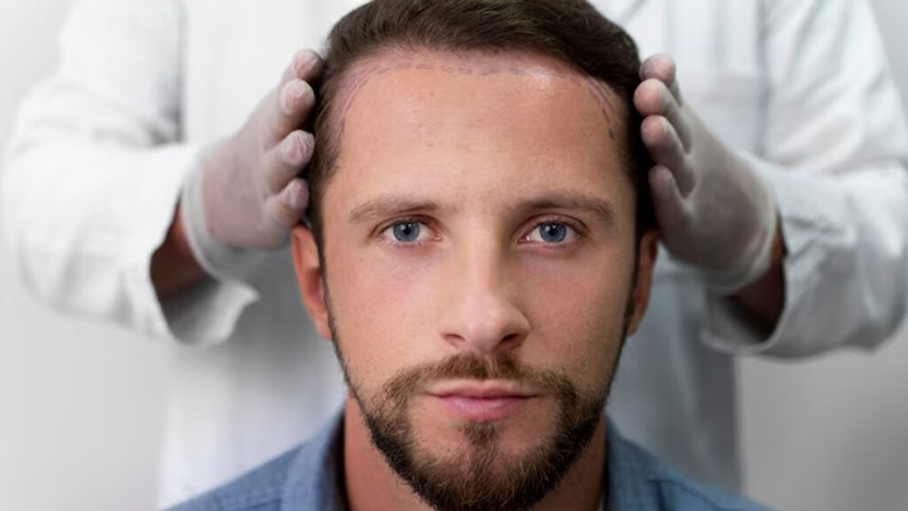 Hair Transplant in Istanbul: Why More and More People from the UK Are Traveling to Turkey