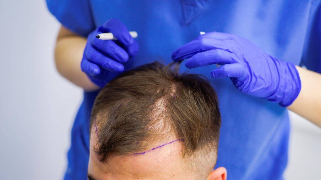 FUE vs DHI: Which Hair Transplant Technique Is Right for You?
