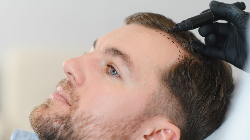 Top Myths & Misconceptions About Hair Transplants Debunked