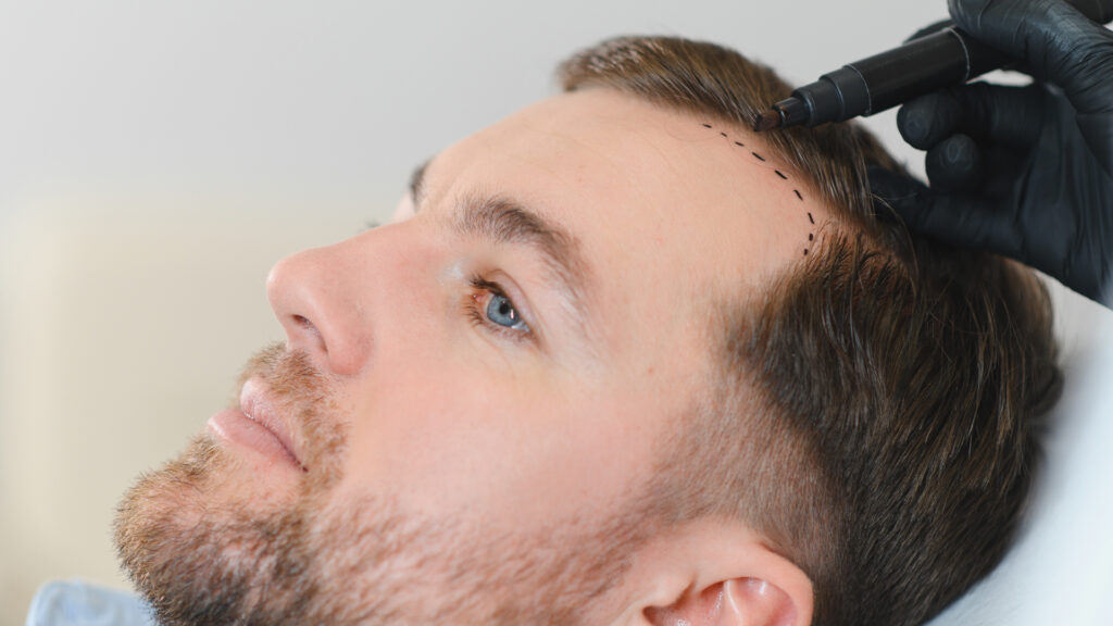 Why Live Hair Clinic in Istanbul Leads the Way in FUE, DHI & No-Shave Transplants