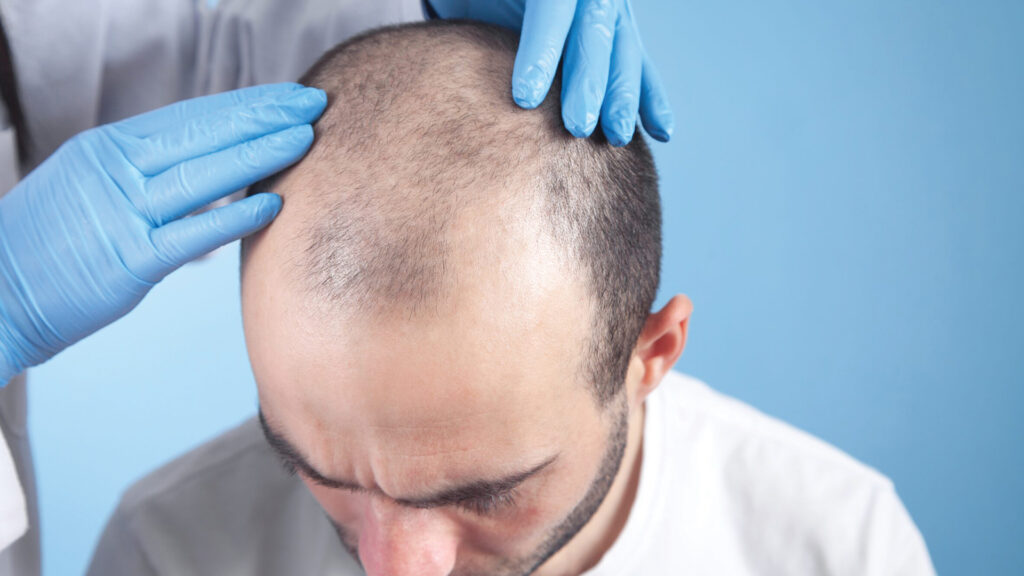Icing After Hair Transplant: What Doctors Really Recommend