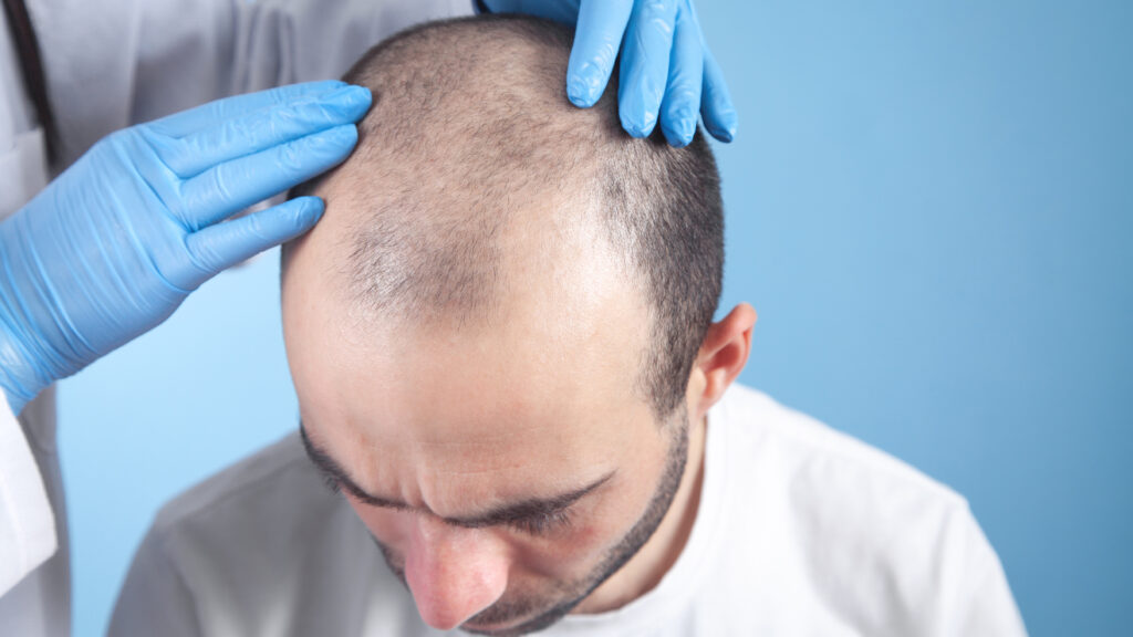 Your Complete Guide to Hair Transplants: Techniques, Benefits, & Why Choose Live Hair Clinic
