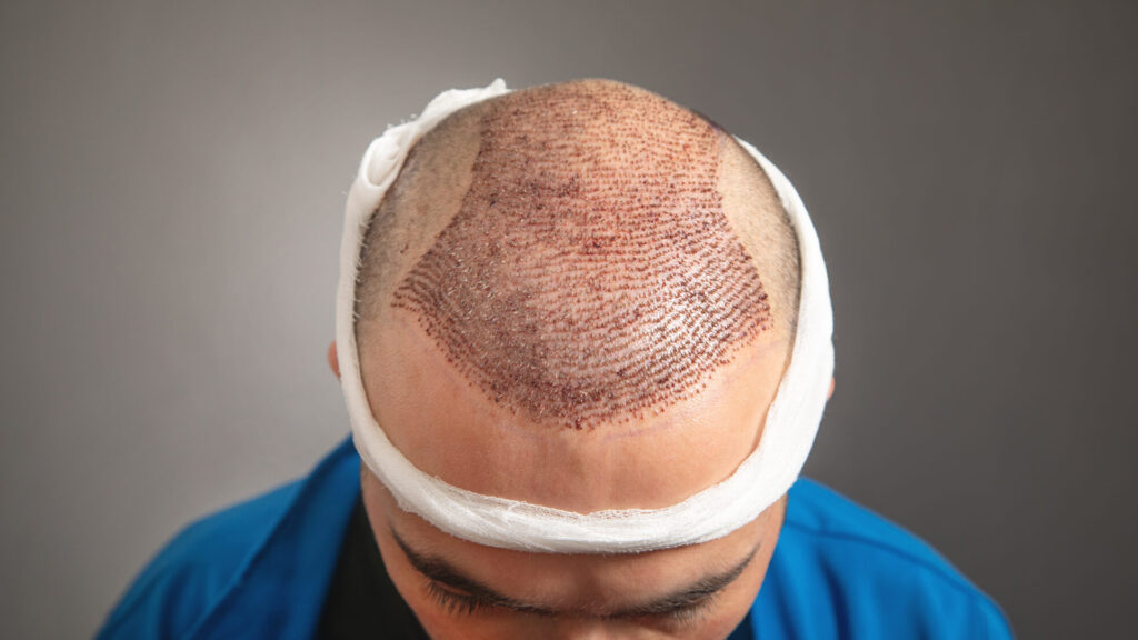 5 Red Flags to Watch Out For When Choosing an Istanbul Hair Clinic