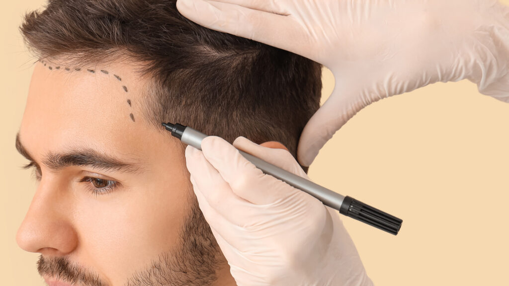 Botched Hair Transplants: Can a Bad Procedure Actually Be Fixed?