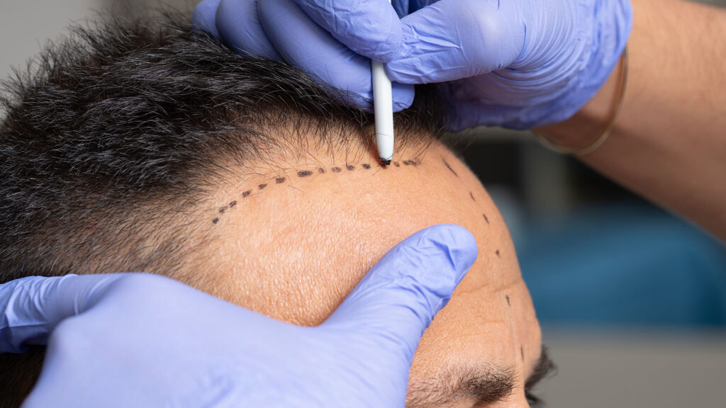From Airport to New Hair: The Complete Timeline of Your Istanbul Medical Vacation