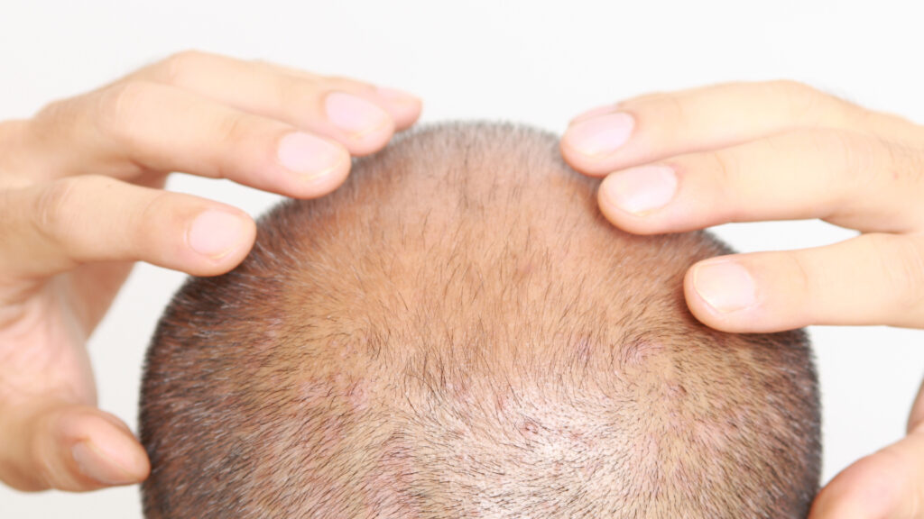 The Emotional Rollercoaster of "Shock Loss": Why Losing Hair After Surgery is Completely Normal