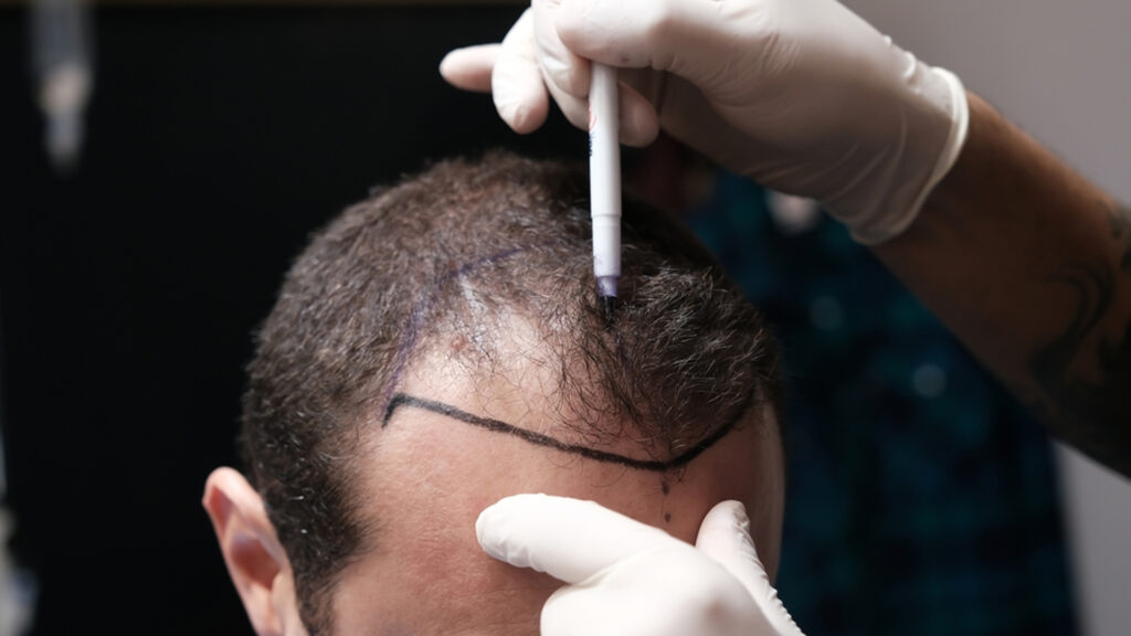 How Many Grafts Do You Really Need for a Severe M-Shaped Receding Hairline?