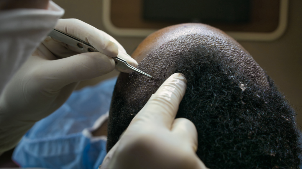 Why Does Shock Hair Loss Occur After Surgery and When Will Permanent Growth Start?