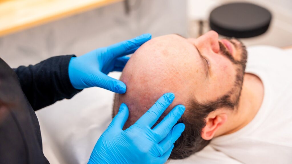 The Complete Hair Transplant Recovery Timeline: Day-by-Day Guide